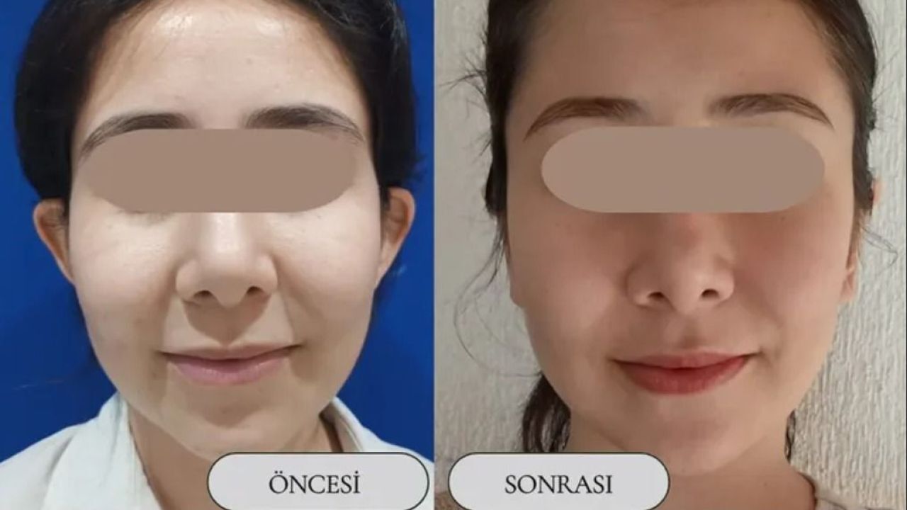 Aksaray Özel İnova Hastanesi’nde Yelken Kulak Ameliyatında Başarılı Sonuç